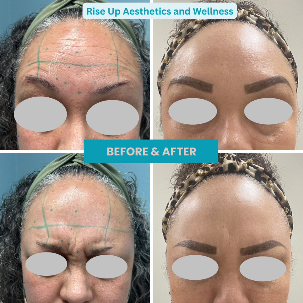 foreheadbeforeandafter